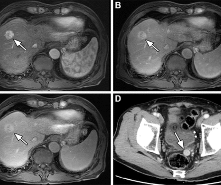 Is Follow-Up Pelvic CT Coverage Necessary for Patients Treated for Hepatocellular Carcinoma?