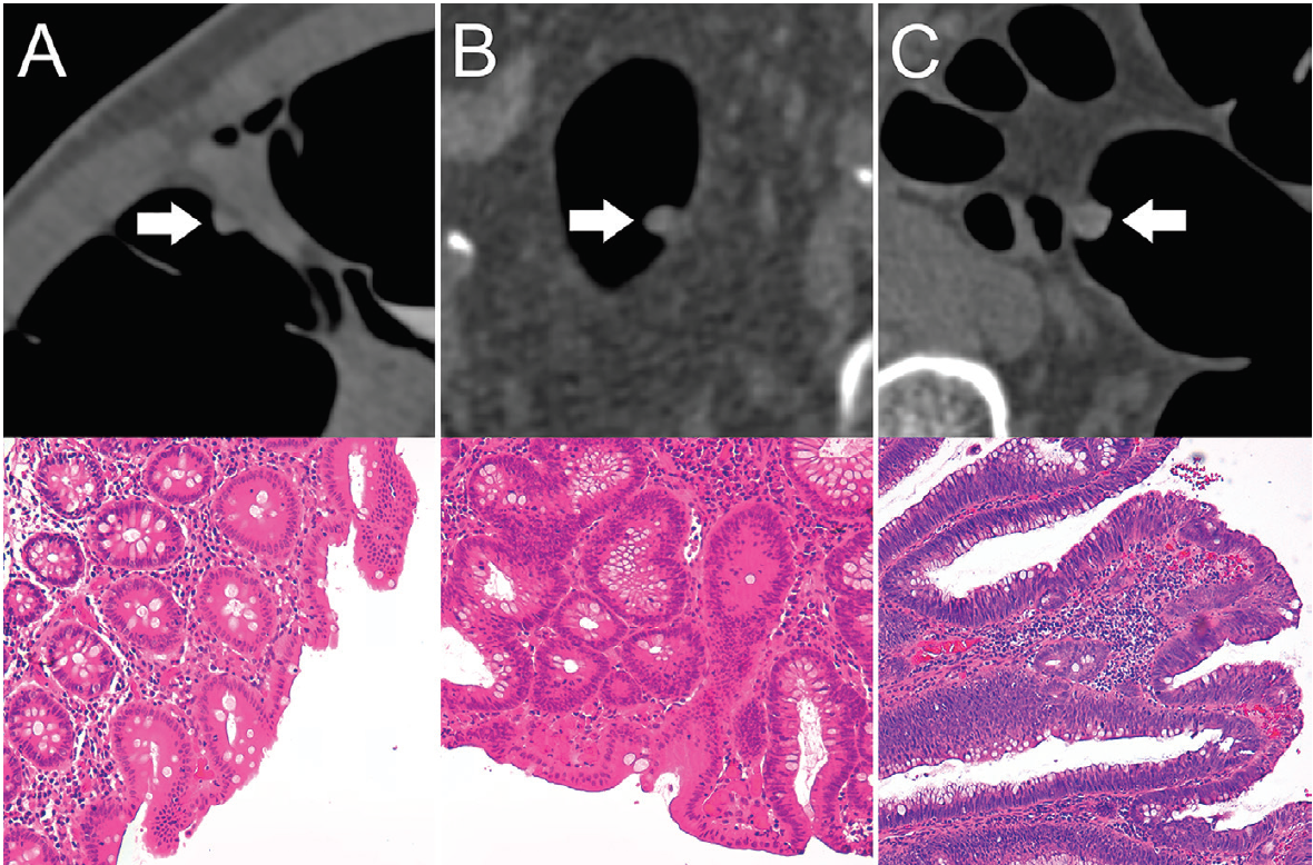 Top: Axial CT colonography images show representative colorectal polyps (arrow) in the training set. Bottom: Corresponding histopathologic work-up. (Hematoxylin-eosin staining; original magnification 320.) A, An 8-mm hyperplastic polyp in the ascending colon of a 54-year-old woman with hyperplastic epithelia. B, An 8-mm tubular adenoma in the sigmoid colon of a 68-year-old man with tubular growth pattern and elongated nuclei. C, An 11-mm tubulovillous adenoma in the rectum of a 73-year-old man with tubulovillous growth pattern and elongated nuclei.

Courtesy: RSNA