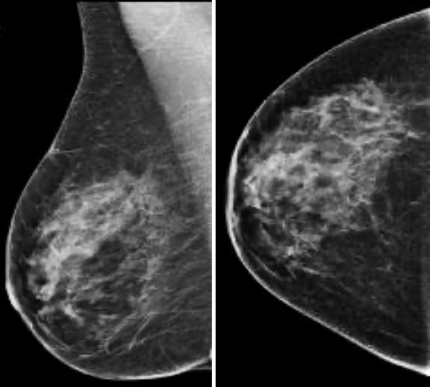 Digital Breast Tomosynthesis on Track to Replace Digital Mammography