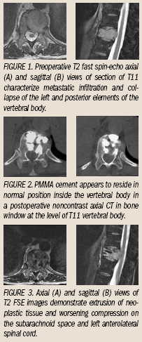 Postprocedural complication of vertebroplasty