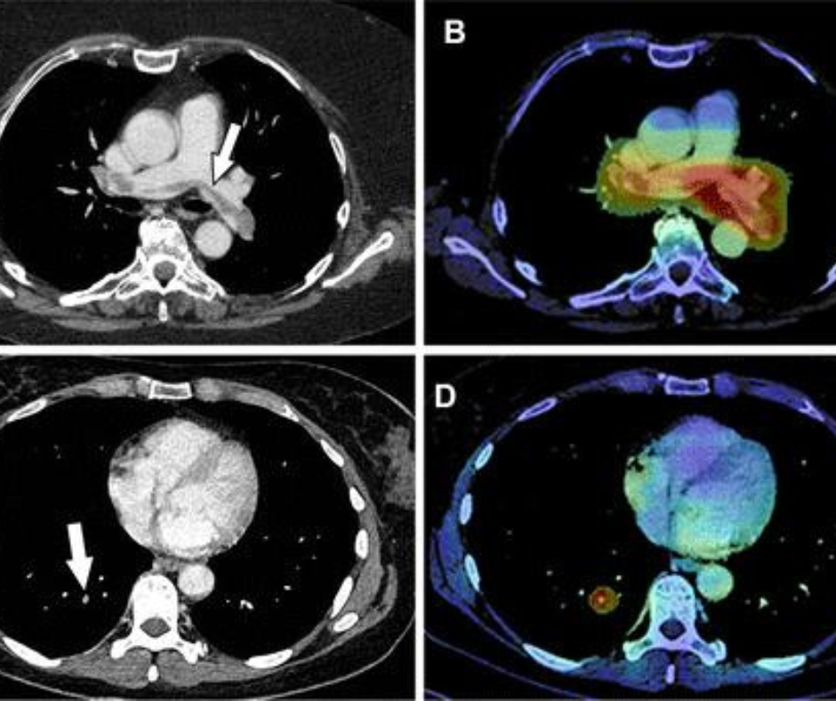 Emerging AI Tool Improves Worklist Triage and CT Detection of Incidental Pulmonary Embolism