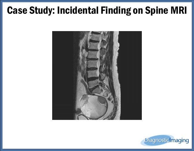 Incidental Finding on Spine MRI
