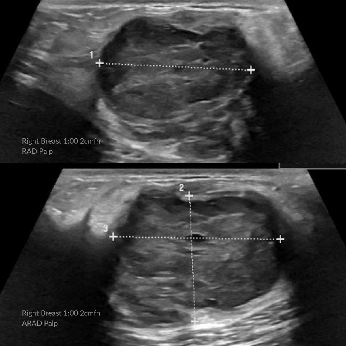 Image IQ Quiz: 25-Year-Old Patient with Enlarging Breast Mass