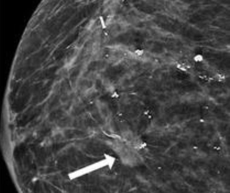 What a New Mammography Study Reveals About Surveillance Imaging in Women Treated for Ductal Carcinoma In Situ
