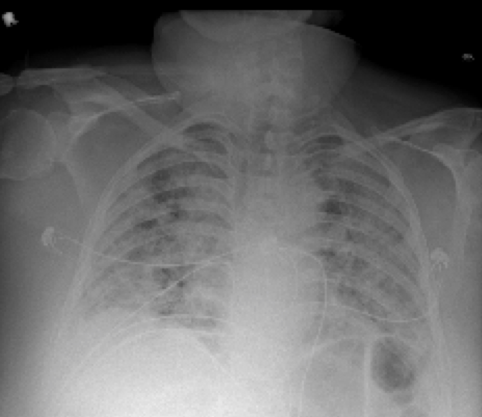 Chest X-ray from patient severely ill from COVID-19, showing (in white patches) infected tissue spread across the lungs

CREDIT Courtesy of Nature Publishing or npj Digital Medicine