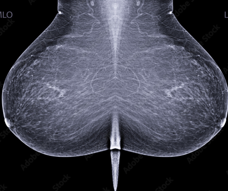 New Study on Digital Breast Tomosynthesis Shows Benefits of Spot Compression Views