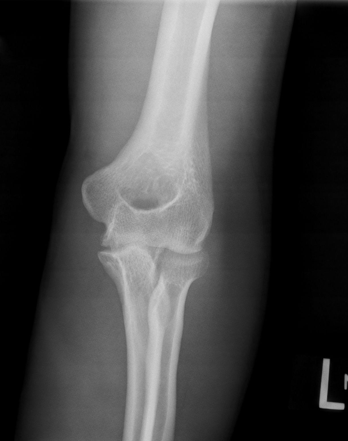 Image IQ: 23-year-old Male with Elbow Pain
