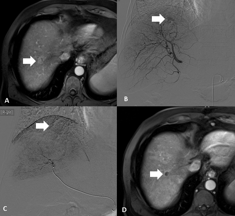 Figure 2. 63-year-old male with cirrhosis. A) Contrast-enhanced MRI in arterial phase shows a 2 cm enhancing lesion near the dome (arrow), consistent with HCC. Due to the location of the lesion, the patient was treated with drug-eluting bead transarterial chemoembolization (DEB-TACE). B) Digital subtraction angiography with the microcatheter in right hepatic artery shows the hypervascular HCC in the dome (arrow). C) Digital subtraction angiography after DEB-TACE shows no residual flow to the tumor (arrow). D) Contrast-enhanced MRI in arterial phase obtained approximately four weeks after DEB-TACE shows a complete response to treatment (arrow).