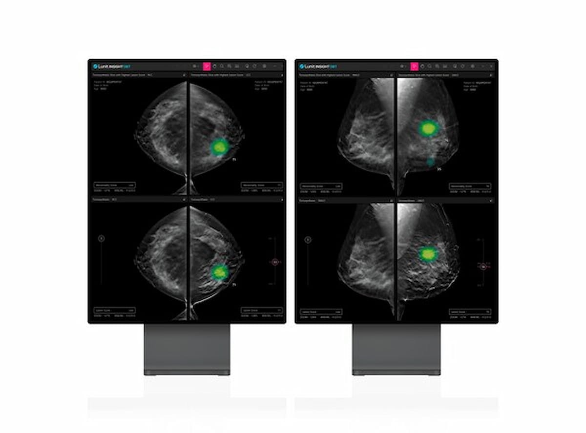 FDA Clears Lunit’s AI-Powered Digital Breast Tomosynthesis Platform