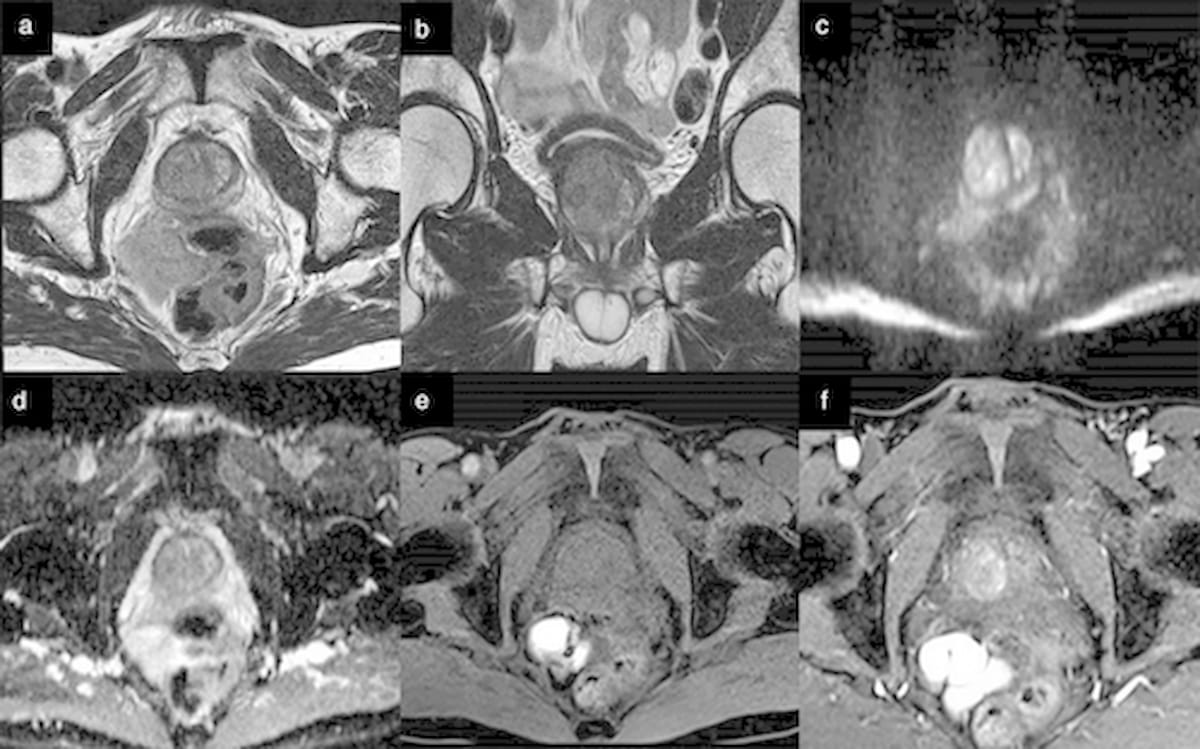 Seven Takeaways from Recent Review on Prostate MRI Imaging Quality