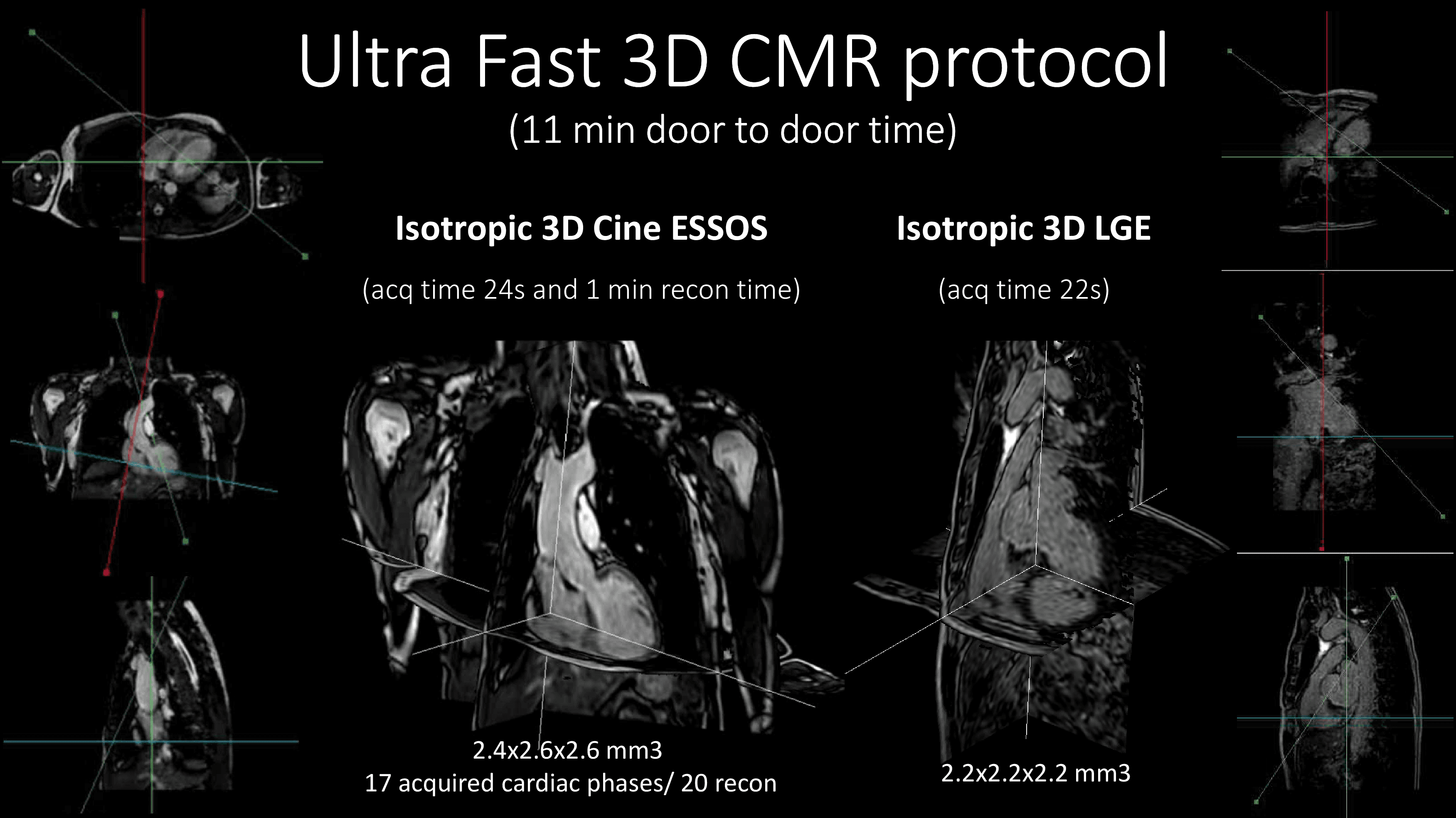 Ultra-fast 3C CMR Protocol MRI Philips