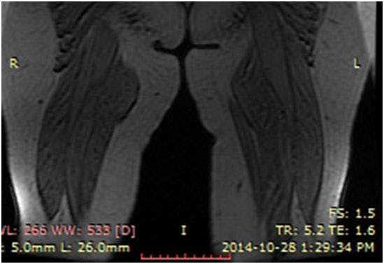 Image IQ: 74-year-old Female, Soft Swellings Around Knees, Thighs