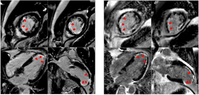 High-Performance, Low-Field MRI Provides Diagnostic Quality in Heart Attack Patients