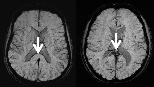 MRI Shows Mountain Climbers Face Higher Risk of Brain Bleeds