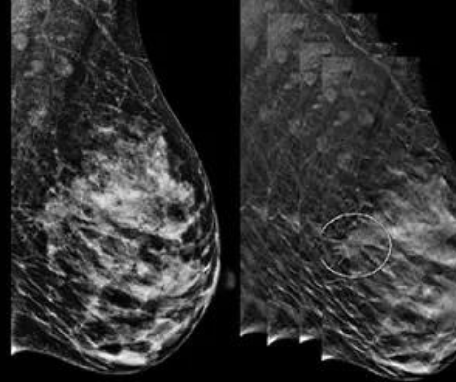Is Digital Breast Tomosynthesis Superior to Digital Mammography?