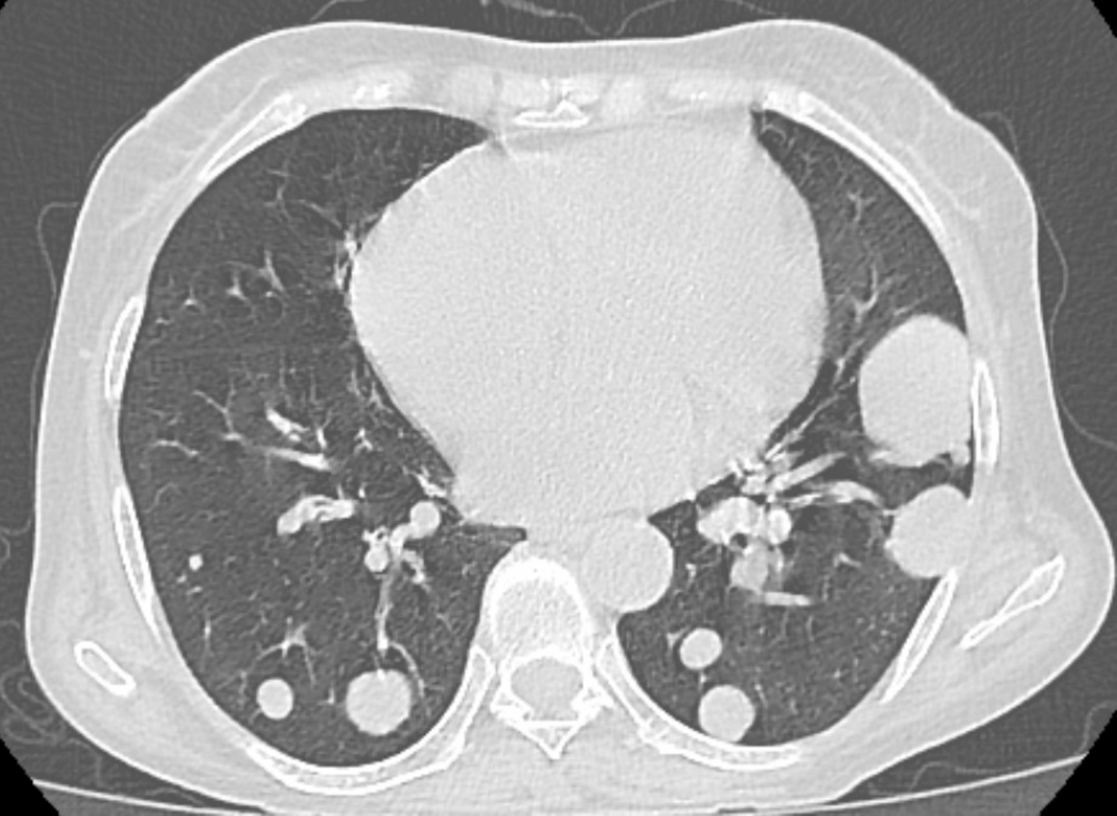 Can Increased Post-Op Surveillance Chest CT Have an Impact for Colorectal Cancer Patients?