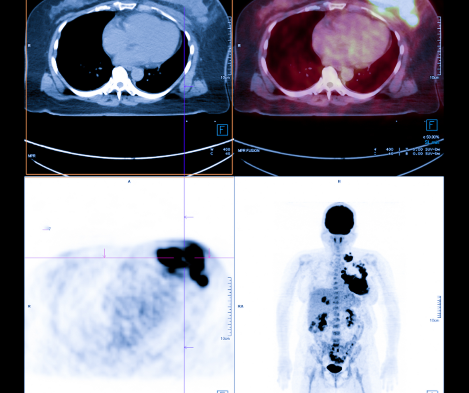 Is PET/CT Better than CT for Monitoring Metastatic Breast Cancer Treatment?