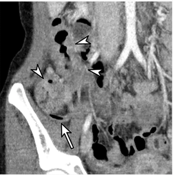 In a 22-year-old woman with right lower quadrant pain, coronal contrast-enhanced lower-dose (2 mSv) CT scan obtained with 4.0-mm section thickness and 1.0-mm reconstruction interval shows normal appendix with internal air density (arrow). Patient was categorized to high-probability group for appendicitis by three of five scoring systems (adult appendicitis score, appendicitis inflammatory score, and modified Alvarado score), but as negative at CT. Colitis was suggested as an alternative diagnosis at CT (arrowheads). Patient recovered without surgery.

Credit: RSNA