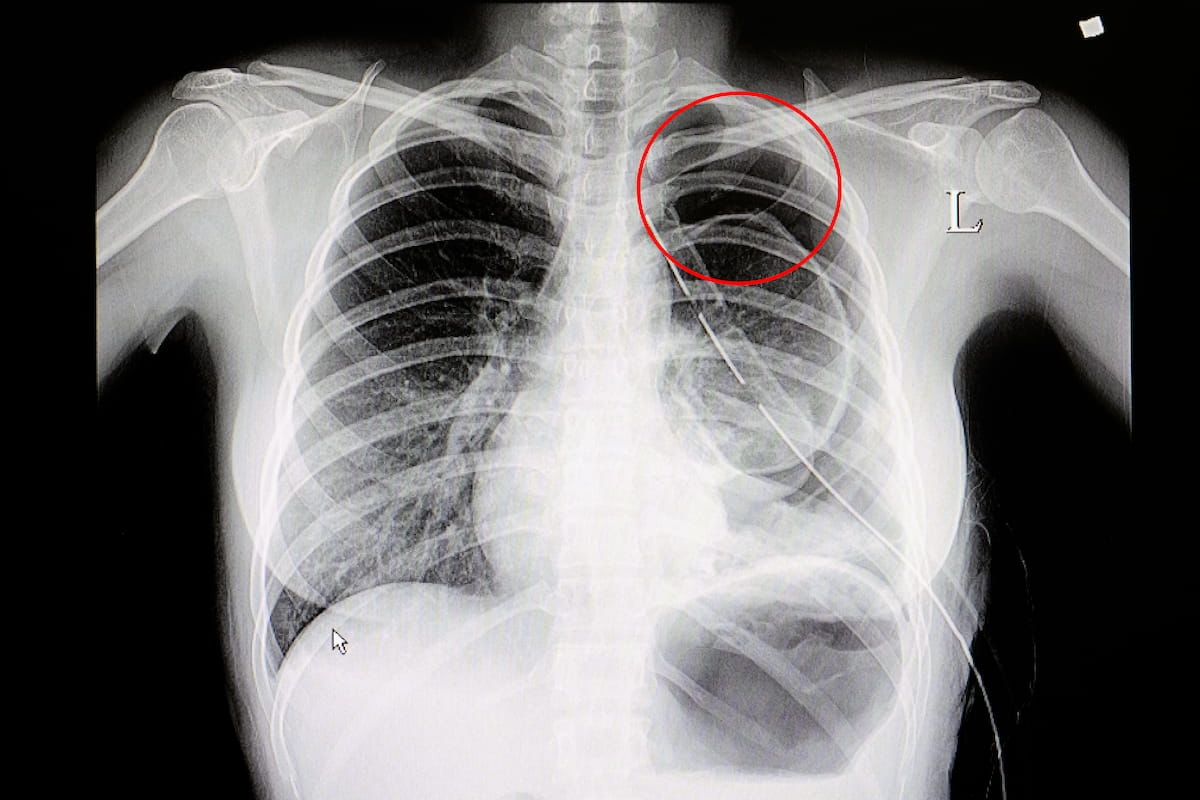 FDA-Cleared AI Triage Software for Chest X-Rays Offers Enhanced Detection of Pleural Effusion and Pneumothorax