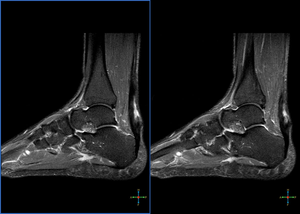 Image IQ Quiz: 25-Year-Old Soccer Player with Posterior Foot Pain