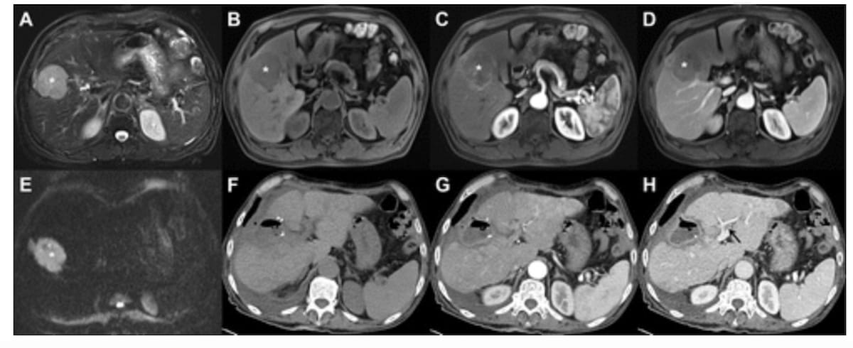 Emerging Model with Key MRI Feature Improves Prediction for Advanced Recurrence of Hepatocellular Carcinoma