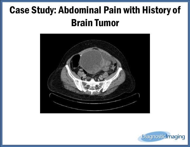 Abdominal Pain with History of Brain Tumor