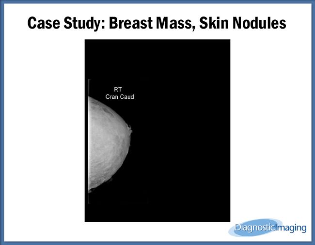 Breast Mass, Skin Nodules