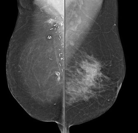 In breast discharge, mammogram unremarkable but ductography definitive