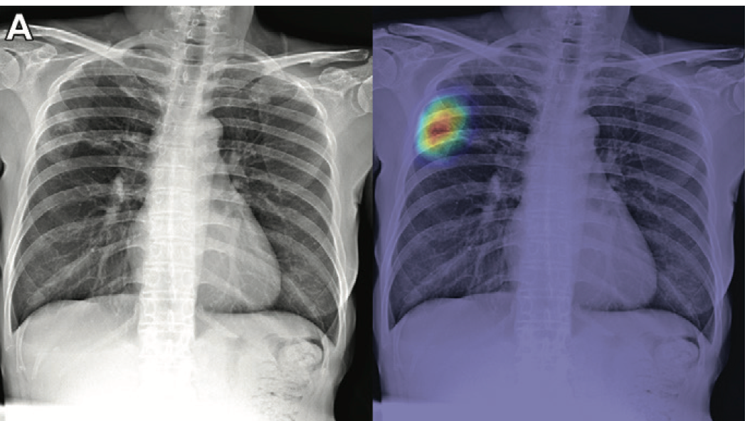 Chest X-Ray Algorithm on Par with Radiologists for Tuberculosis Detection