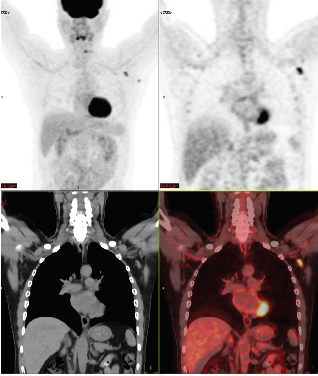 A 63-year-old multiple myeloma patient, with skeletal pain. New FDG avid axillary lymphadenopathy 62 days (9 weeks) after second mRNA vaccine dose.

Credit: RSNA