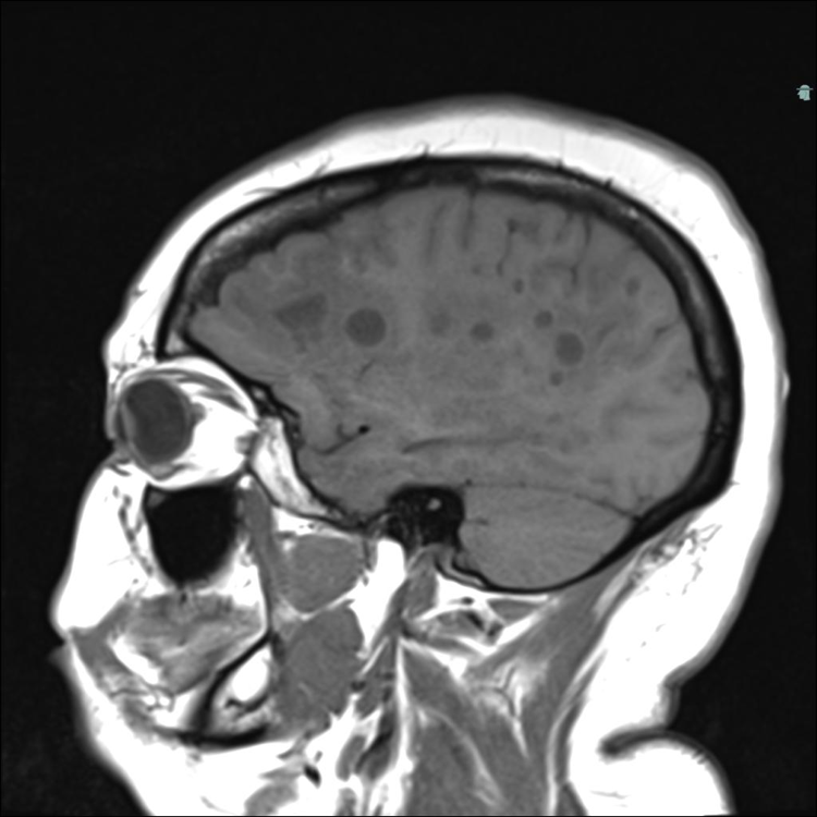 Image IQ: Patient with Vertigo, Episodic Dysarthria and Lower-Left Extremity Weakness