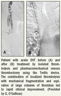 Interventional approach offers fast deep vein thrombosis relief