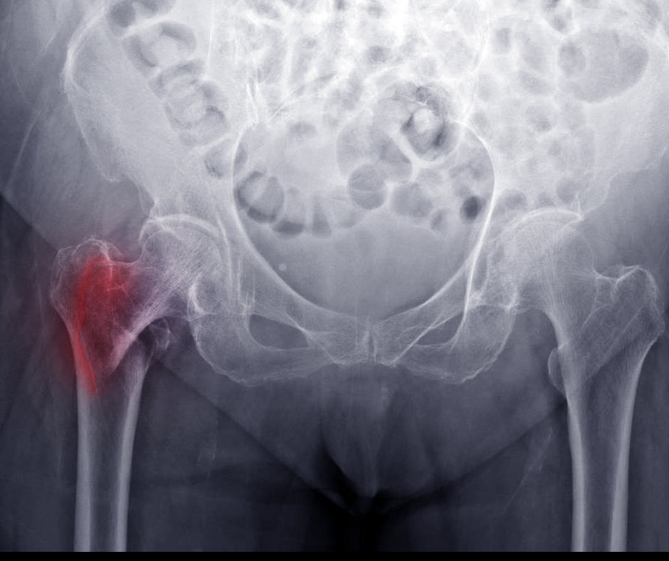 Study Looks at Deep Radiomics Approach for Diagnosing Osteoporosis on Hip X-Rays