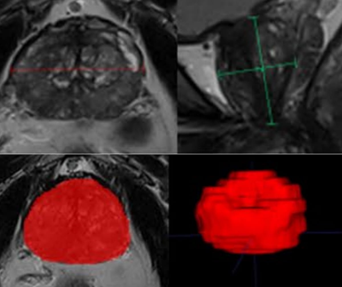 Study Shows Benefits of AI for Prostate Cancer Detection on Multiparametric MRI