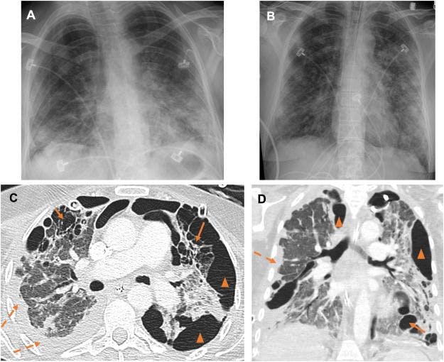 New Chest Imaging Study Finds Intrathoracic Complications in 20 Percent of Patients with COVID-19