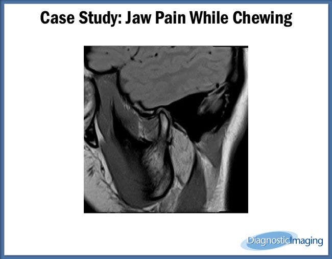 Jaw Pain While Chewing
