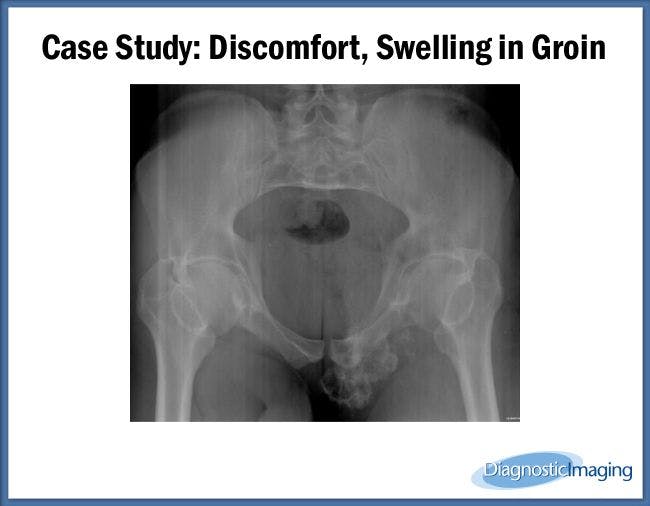 Discomfort, Swelling in Groin