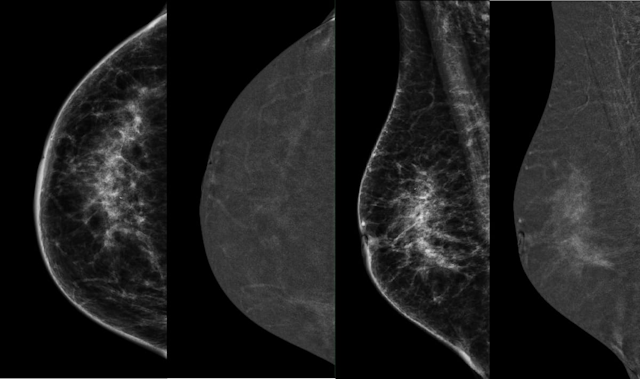 Five Insights on Artifacts and Limitations with Contrast-Enhanced Mammography