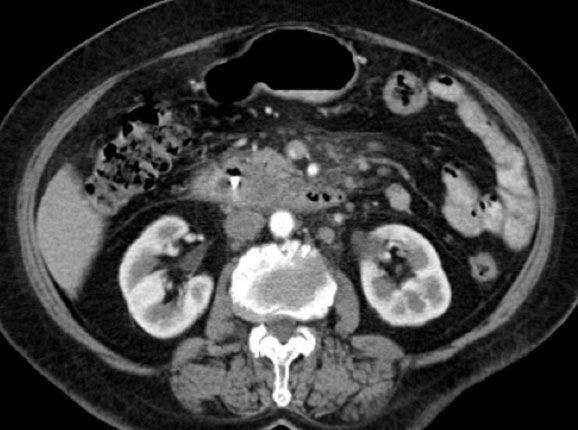 Periampullary Carcinoma with ERCP-induced Pancreatitis