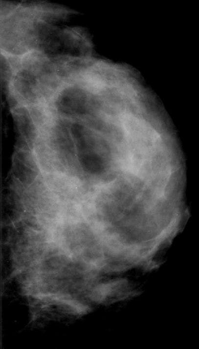 Image IQ: 47-year-old with Irregular Mass in Dense Breast Tissue