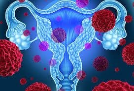 Transvaginal Ultrasound Not Effective for Endometrial Cancer Screening with Black Women