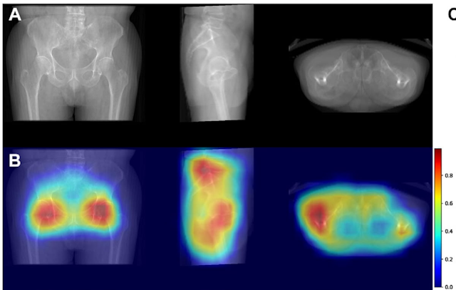 3D Hip CT AI Model Bolsters Future Fracture Risk Assessment for Patients with Hip Fractures