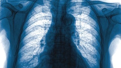 Deep Learning Algorithm Identifies More Missed Lung Cancers on X-ray