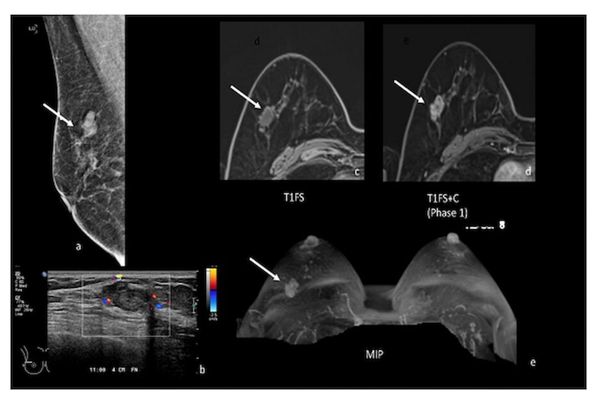 Study: Abbreviated Breast MRI and DBT Offer Comparable Breast Cancer Detection in Dense Breasts