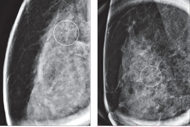 What New Mammography Research Reveals About Radial Scars Detected with Digital Breast Tomosynthesis