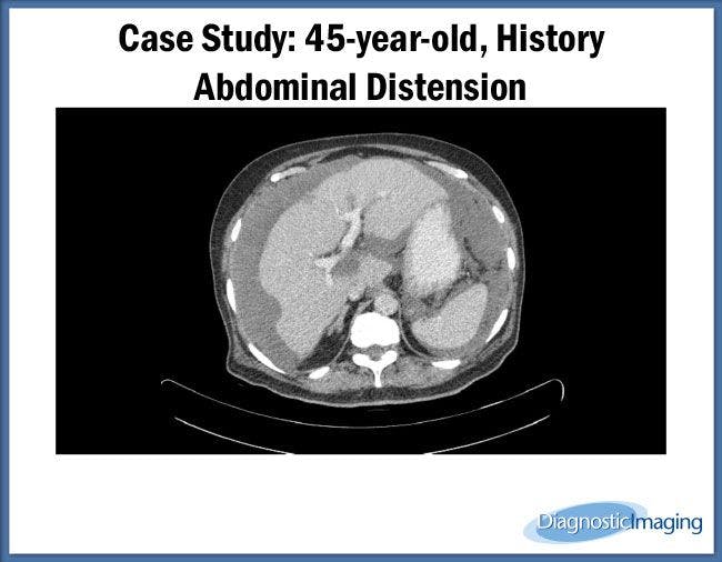45-year-old, History Abdominal Distension