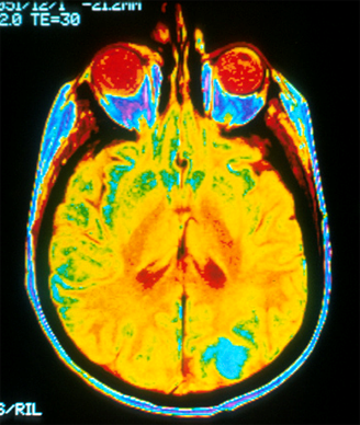 MRI Detects Brain Abnormalities in Migraine Patients