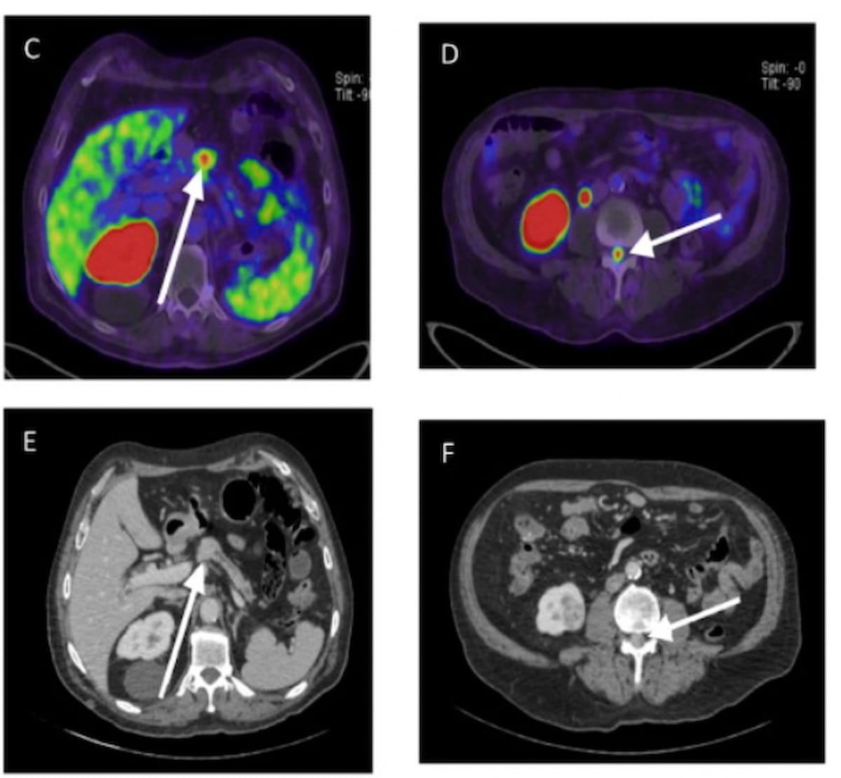 Study: PSMA PET/CT Identifies 18 Percent More Metastatic Renal Cancers than Conventional Imaging