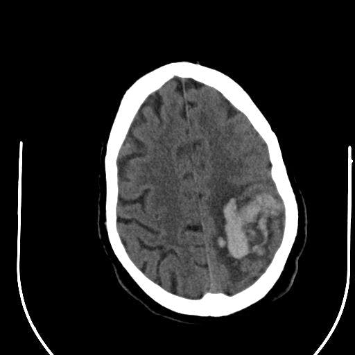 Cocaine Induced Hypertensive Intraparenchymal Hemorrhage