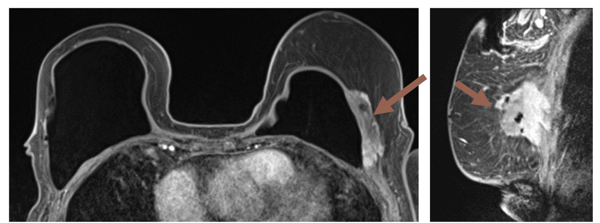 Breast Reconstruction: Current Principles and Emerging Concepts in Imaging